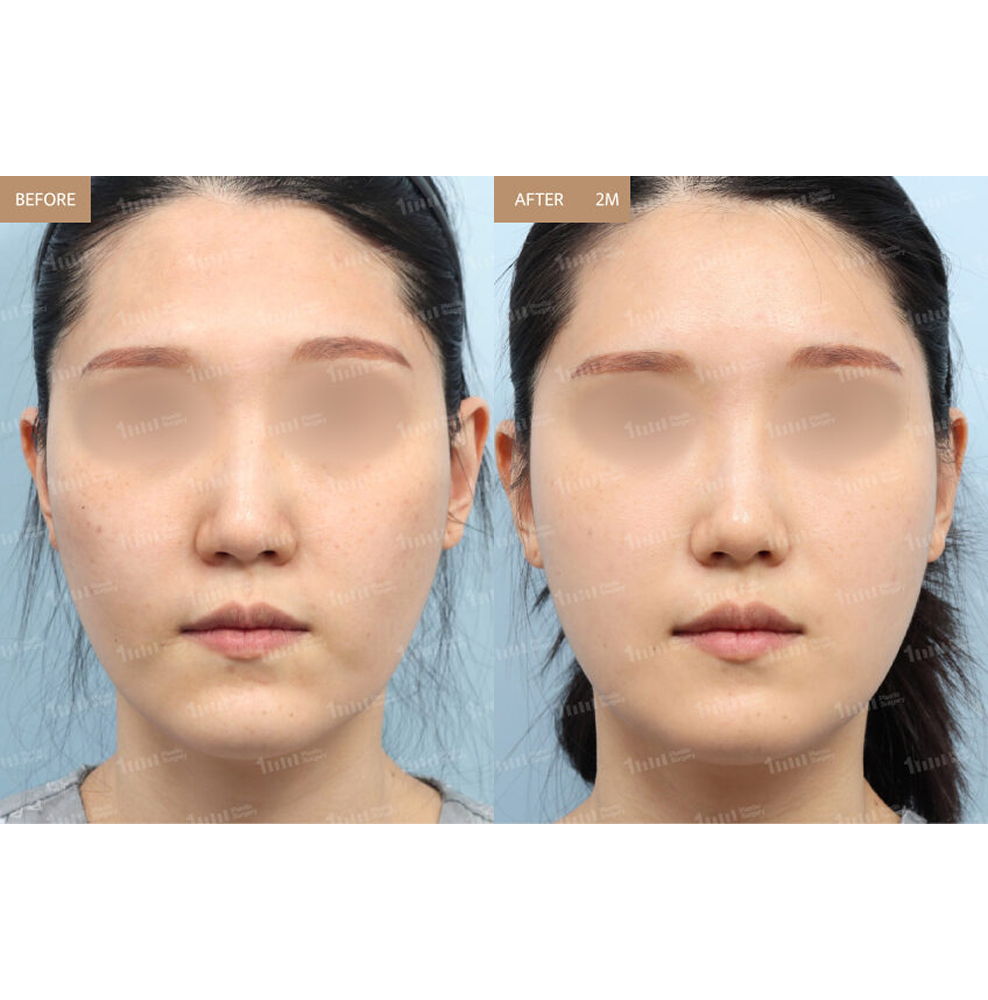 Full Face Fat Grafting Before and After Results at 1MM Plastic Surgery in Korea for Natural Facial Volume Restoration