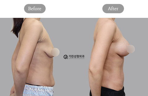 Mommy Makeover Korea Breast Lift Side Before and After Results at Girin Plastic Surgery Clinic