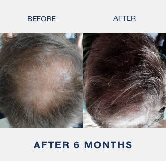 man showing hair loss reversal after using illumiflow 272 pro