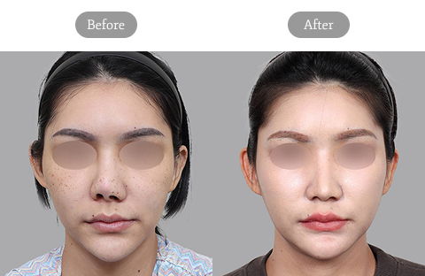 Revision rhinoplasty for contracted nose reconstruction showing restored nasal structure and improved symmetry in Korea