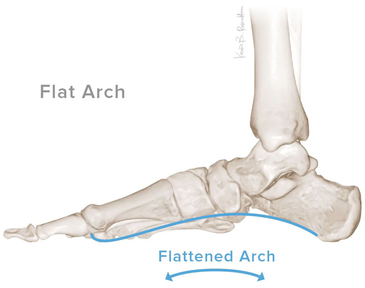 Adult acquired flatfoot — posterior tibial tendon and arch collapse