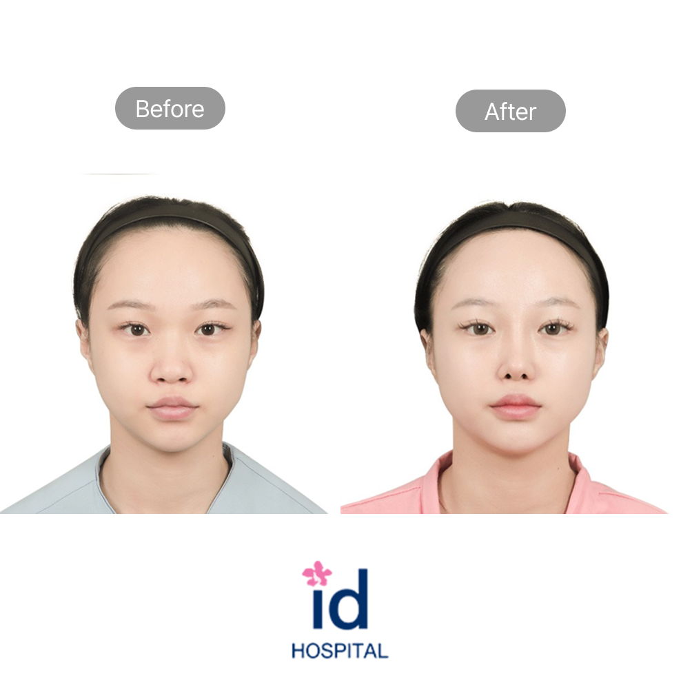 Eye Reshaping Surgery Before and After Result at ID Hospital