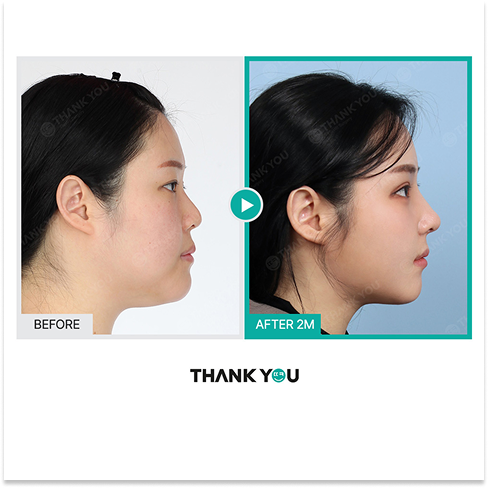 Double Chin Liposuction and Thread Lift Before and After in Korea Showing Improved Side Profile, Sharper Jawline, and Defined Neck Contour After 2 Months