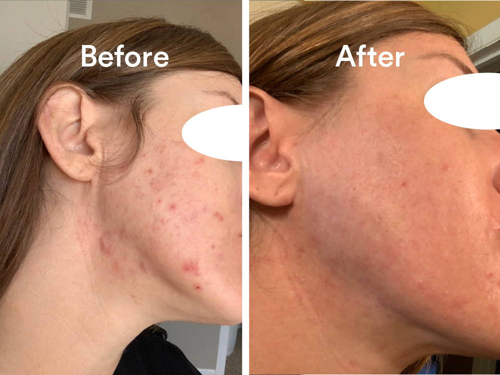 Before and after photos of acne client