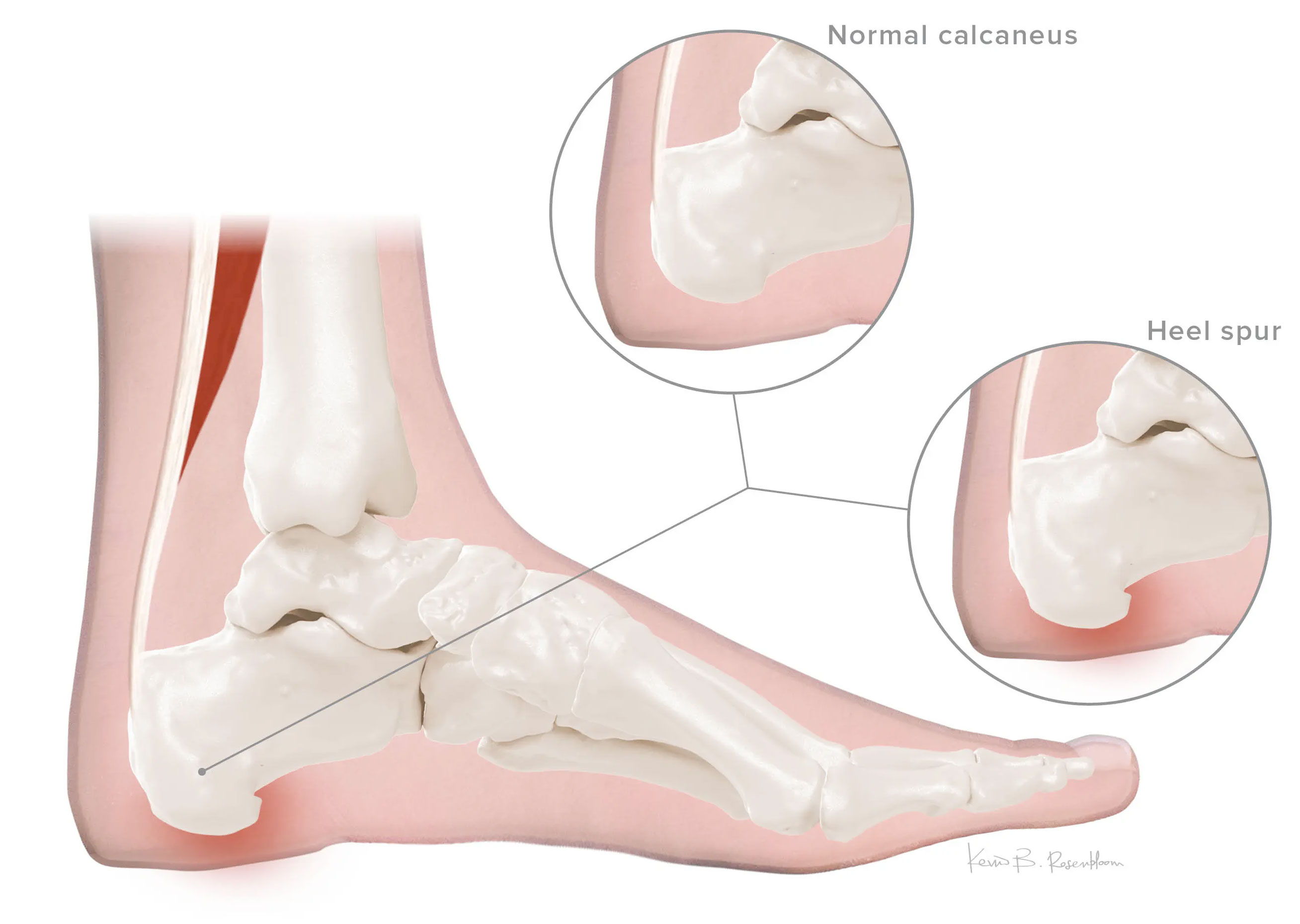 Heel Spur