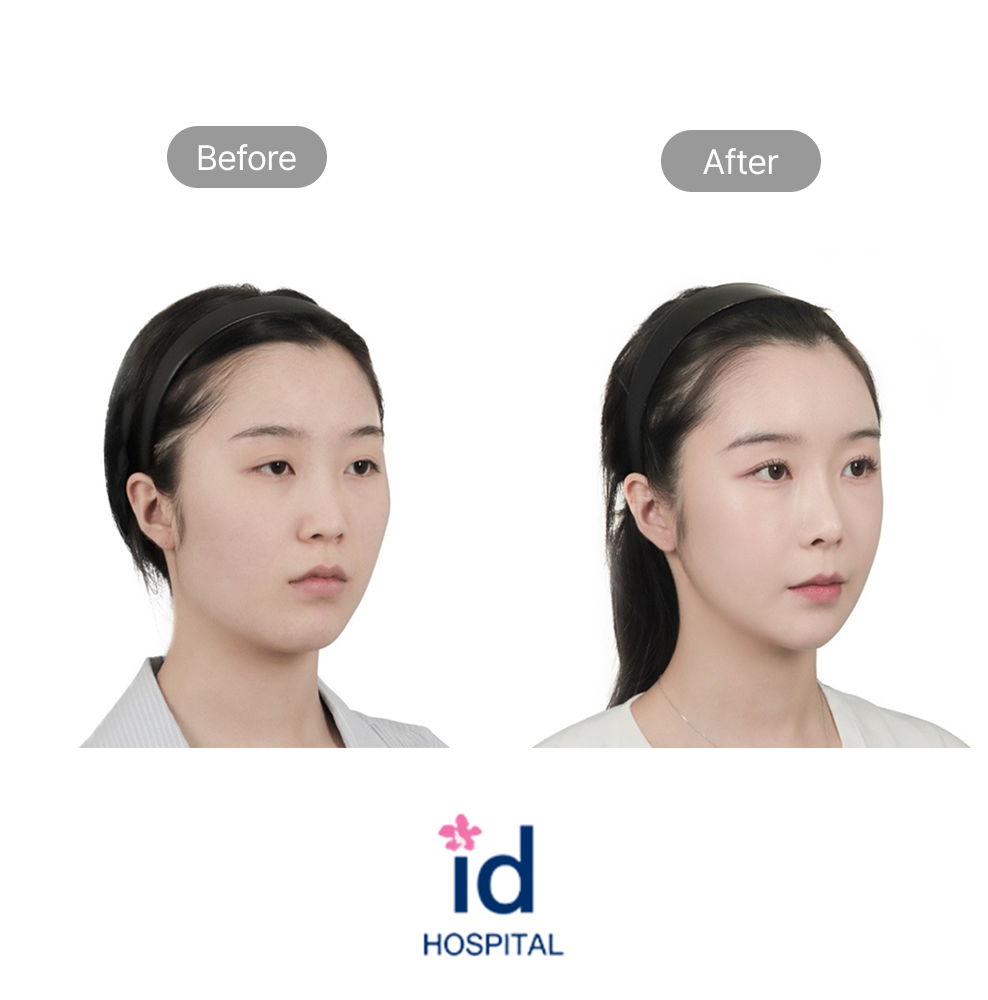 Female Rhinoplasty Before and After Result at ID Hospital