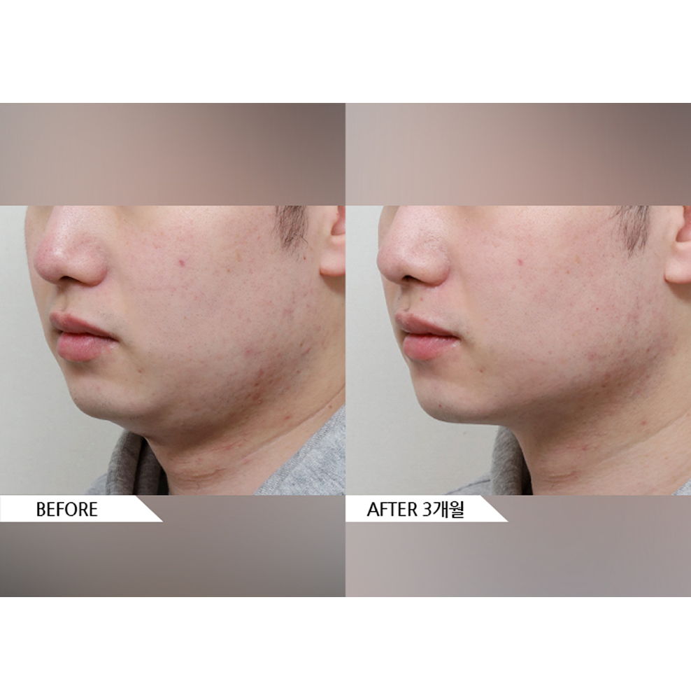 Before and after male facial liposuction combined with jaw botox showing a slimmer V-line jaw and reduced lower face volume 3 months after treatment in Korea