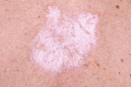 Une photo de bosses blanches sur la peau