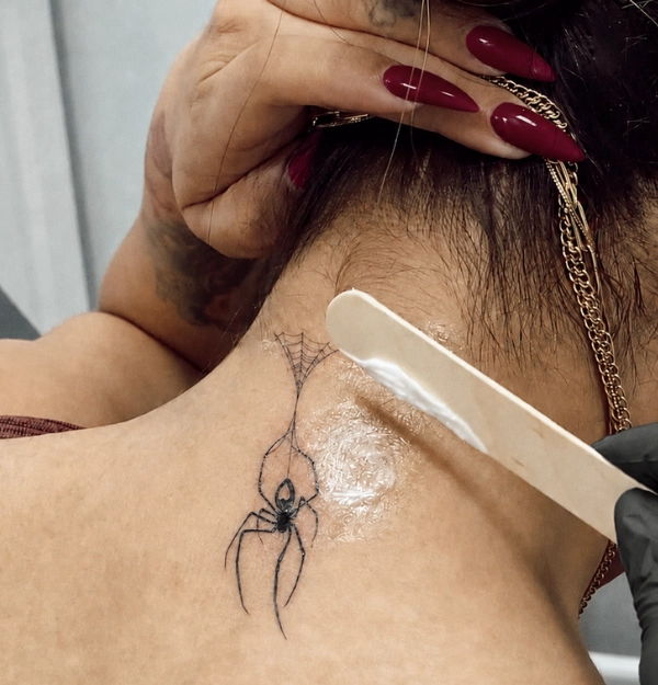 Tattoo removal at Prolase