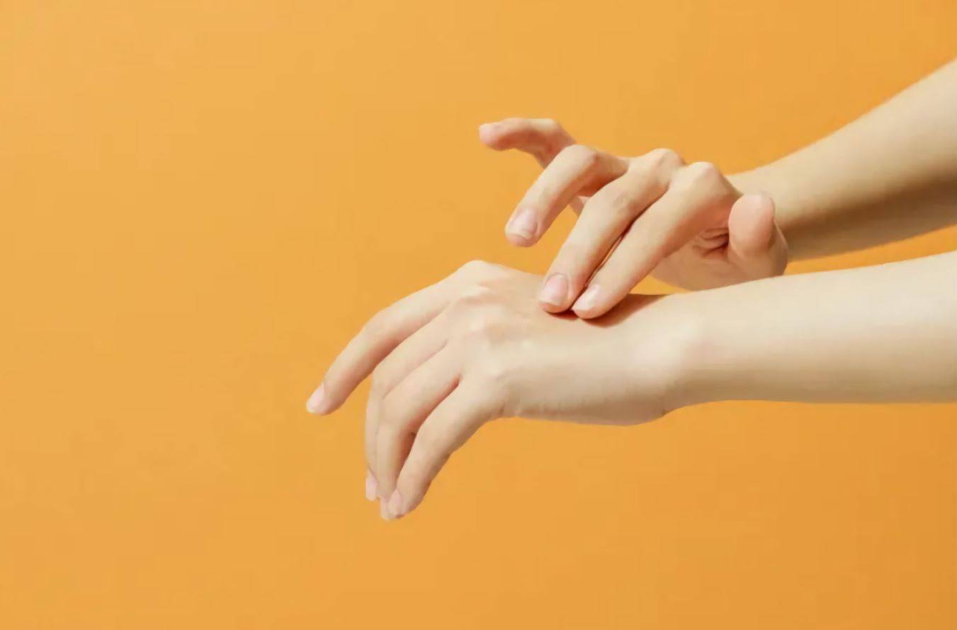 woman applying eczema cream to her hands