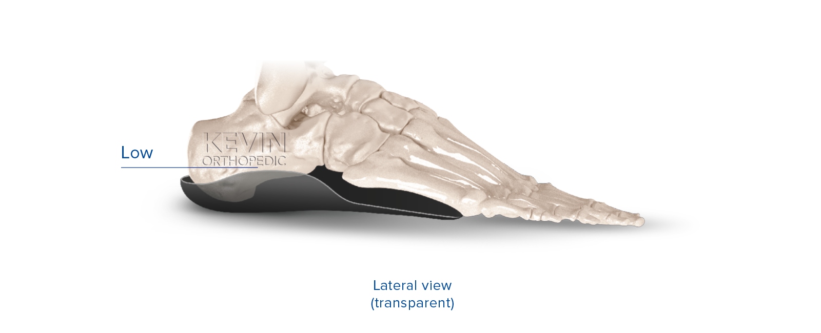 THE CLINIC GUIDE: SUPINATION - Lateral Flange – Kevin Orthopedic Institute