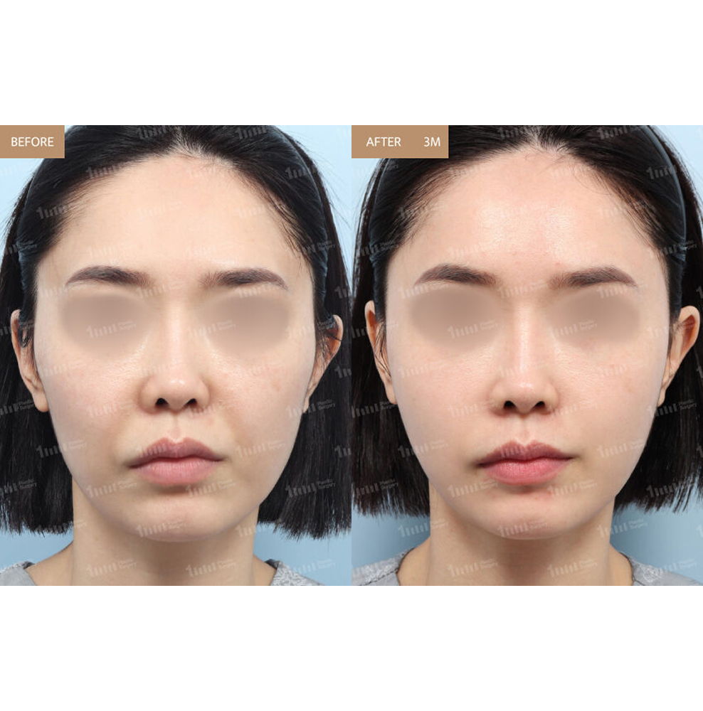 Full Face Fat Grafting Before and After Results at 1MM Plastic Surgery in Korea for Balanced and Youthful Facial Volume