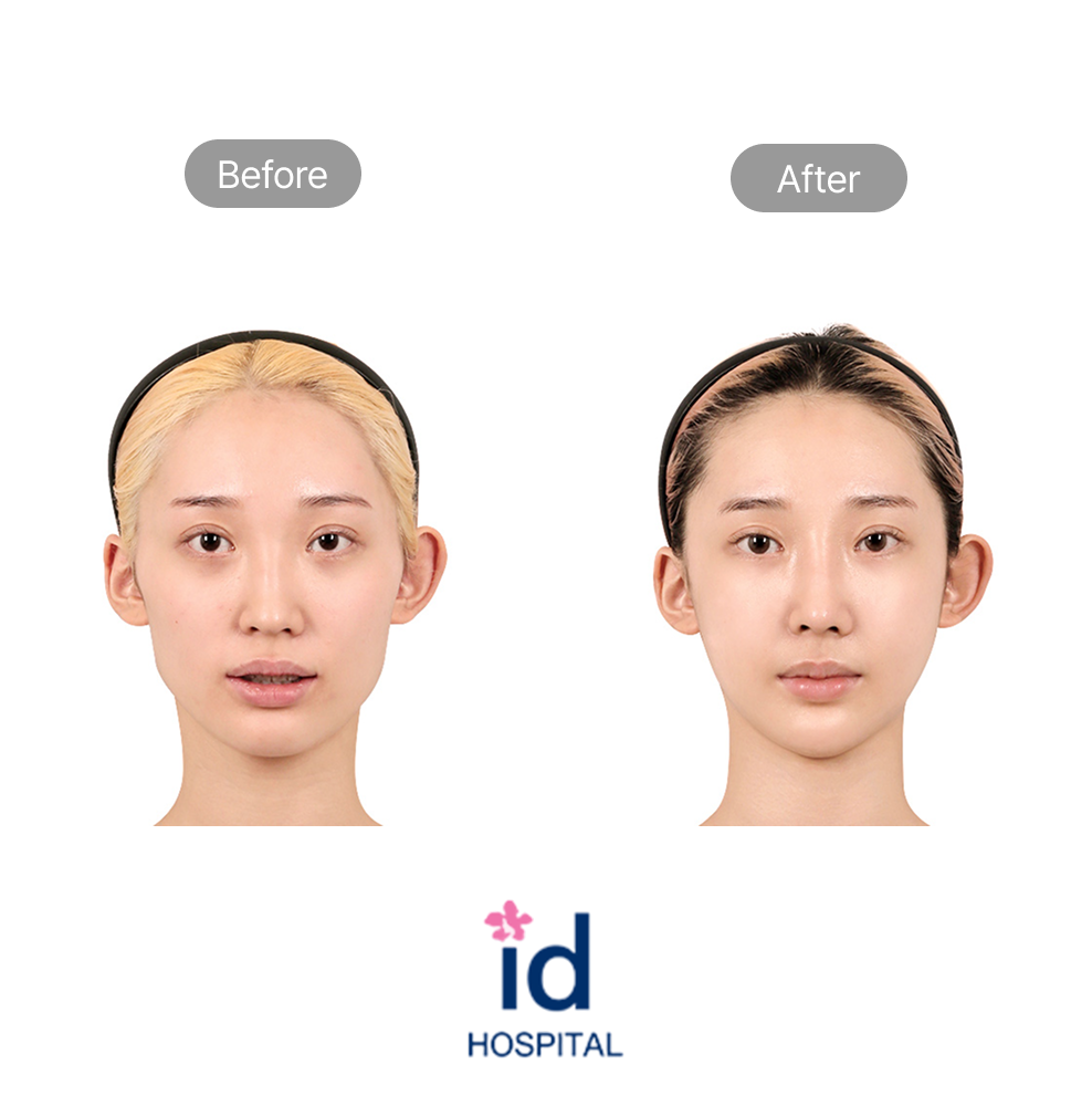 Facial Contouring Two Procedures, Cheekbone Reduction, Chin Reduction, and Mini V-Line Before and After Result at ID Hospital