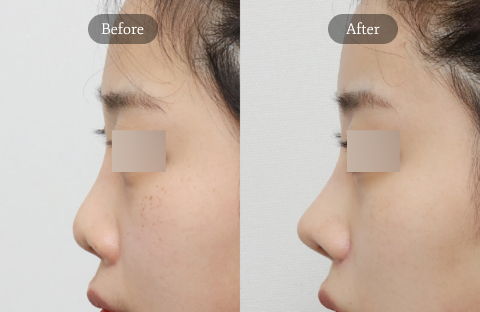 Revision rhinoplasty for bulbous nose correction showing refined nasal tip definition and slimmer profile result in Korea