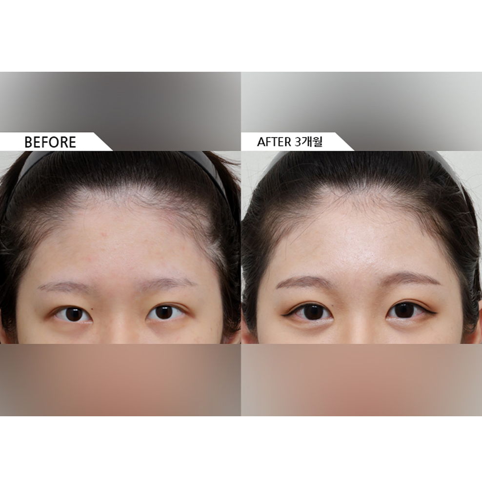 Before and after results of forehead lift surgery showing naturally lifted brows and a smoother, more refreshed appearance 3 months after surgery in Korea