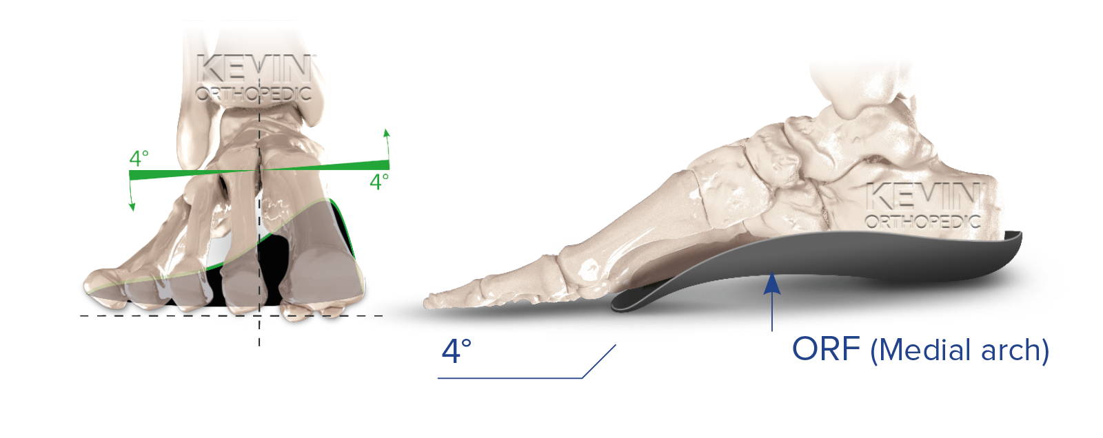 THE CLINIC GUIDE: PRONATION - Heel Skive – Kevin Orthopedic Institute