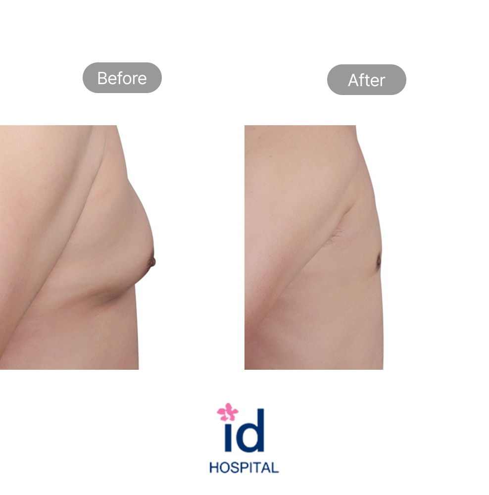 Korean ID Hospital Gynecomastia Surgery Before and After Result