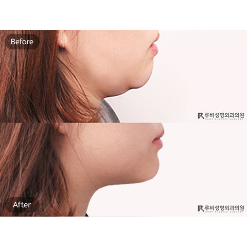 Face Lift Using Threads 3 Months After – Jawline Thread Lift in Korea by Jivaka Beauty