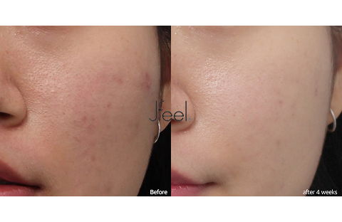 Before and After 4 Weeks of Acne Laser and Aqua Peel Laser Treatment for Face at Jfeel Clinic Korea