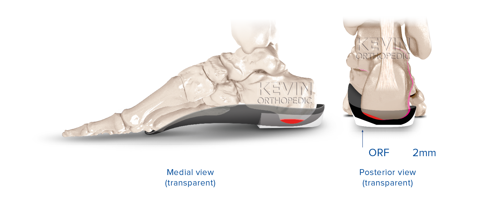 THE CLINIC GUIDE: PRONATION - Heel Skive – Kevin Orthopedic Institute