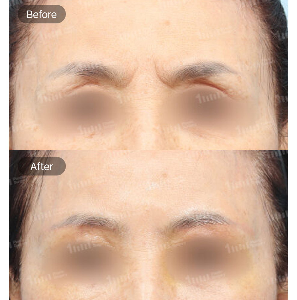 Glabellar Line Filler Before and After Results at 1MM Plastic Surgery in Korea for Smoother Forehead Expression Lines