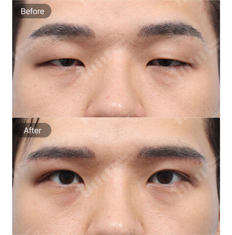 Male Non-Incisional Ptosis Correction Before and After Results at 1MM Plastic Surgery in Korea