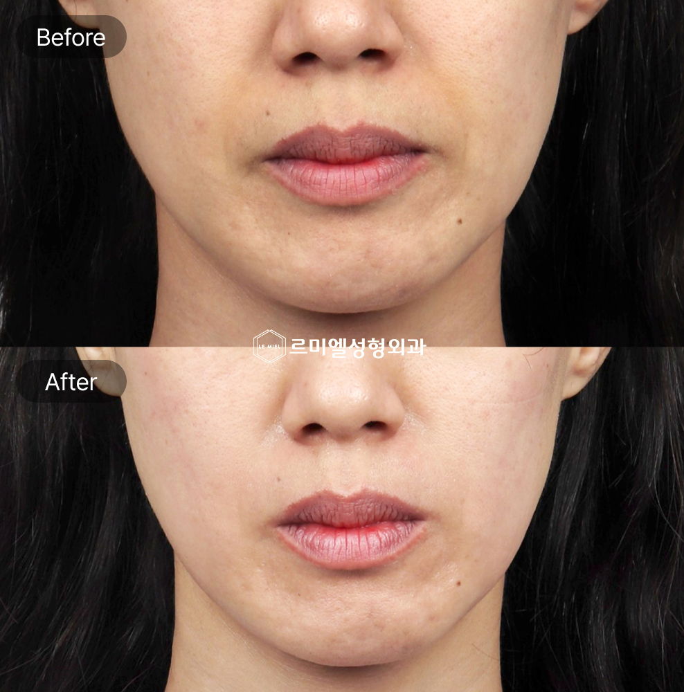 Before and After Results Immediately After EMFACE Lifting Treatment for Facial Contouring