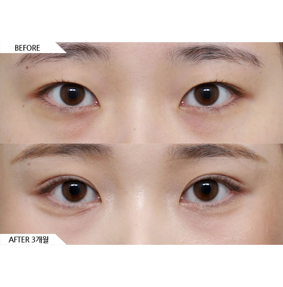 Before and after results of double eyelid revision surgery showing more natural and balanced eye shape in Korea