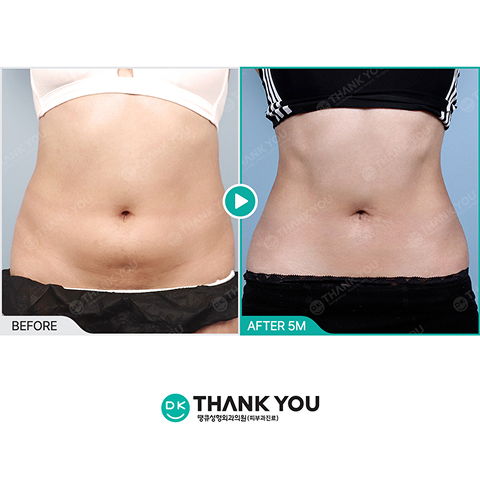 Abdominal Liposuction Body Fat Reduction Before and After Results After 5 Months