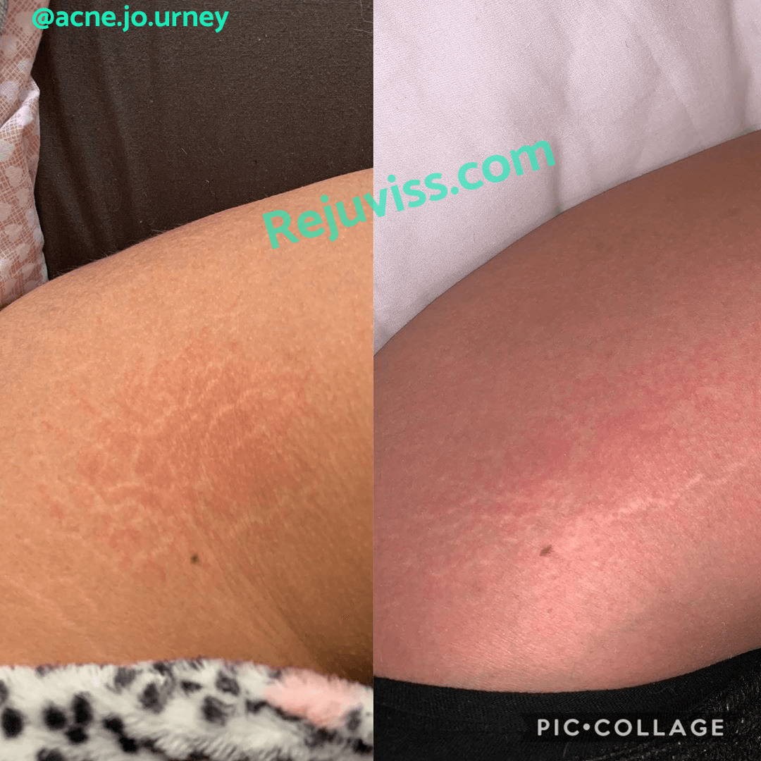 Photo of microneedling before and after for stretch marks
