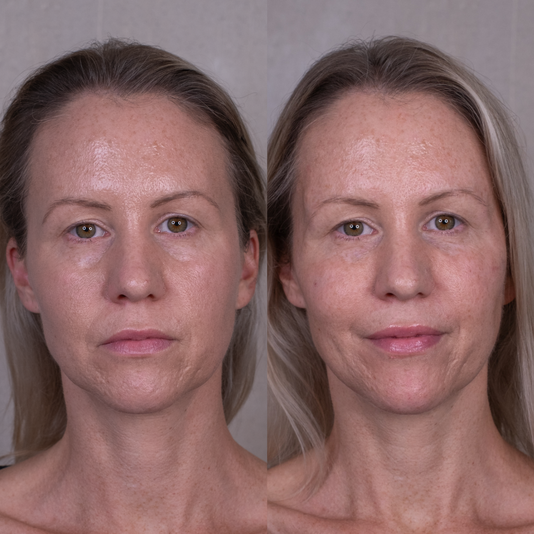 Comparison of two facial images showing different expressions or conditions.