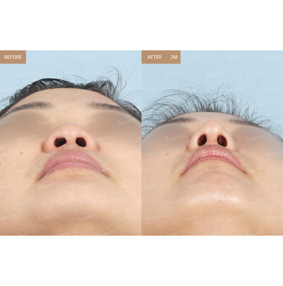 Nose Tip Rhinoplasty Before and After Results at 1MM Plastic Surgery in Korea for a Defined and Refined Nose Tip