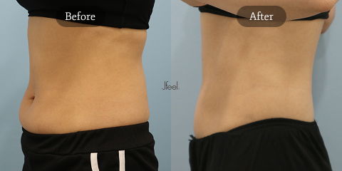 Non-Surgical Body Contouring in Korea for Natural Waistline Definition and Post-Ozempic Body Shaping Results