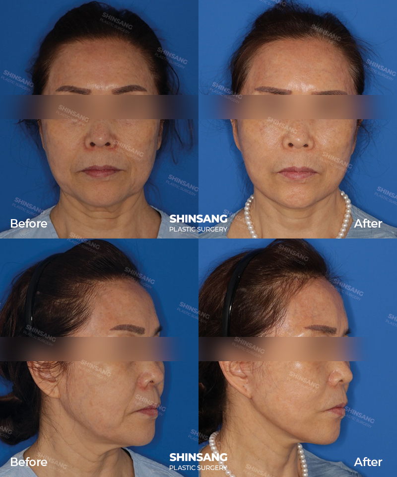 Facial Lifting With Full Facelift Result At Sinsang Plastic Surgery In Korea