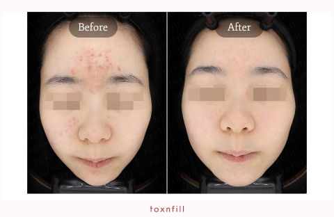 Gold PTT and Neobeam Acne Treatment Before and After for Inflammatory Breakouts