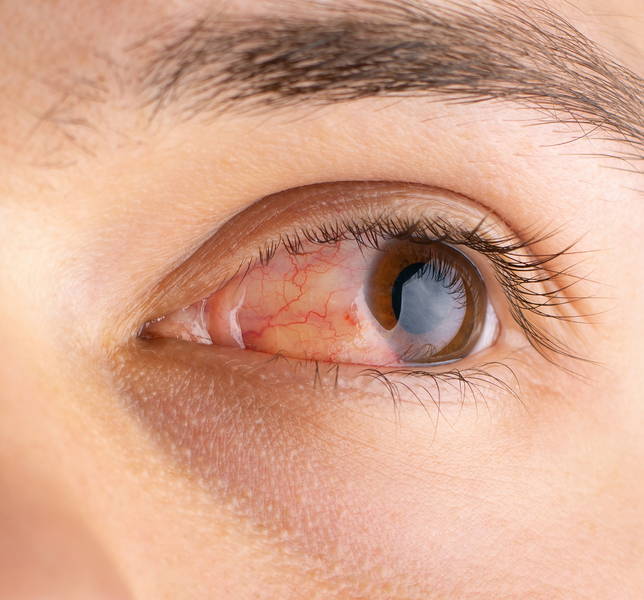 Ein braunes, tränendes und gereiztes Auge mit einer allergiebedingten Bindehautentzündung.