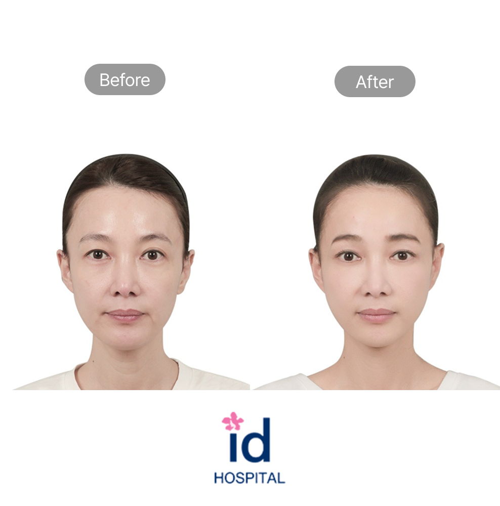 Eye Reshaping With Buried Suture Technique Before and After Result at ID Hospital