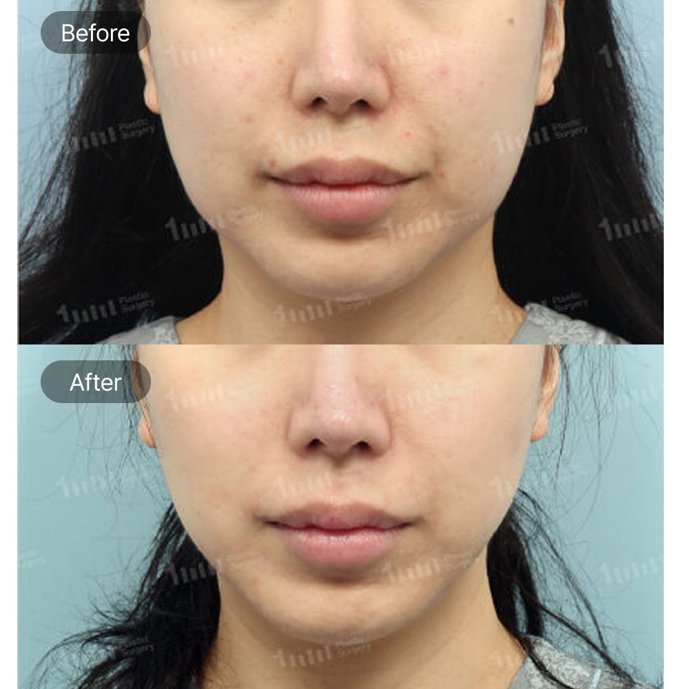 Ultherapy Before and After Results at 1MM Plastic Surgery in Korea for Tighter and More Defined Facial Contours