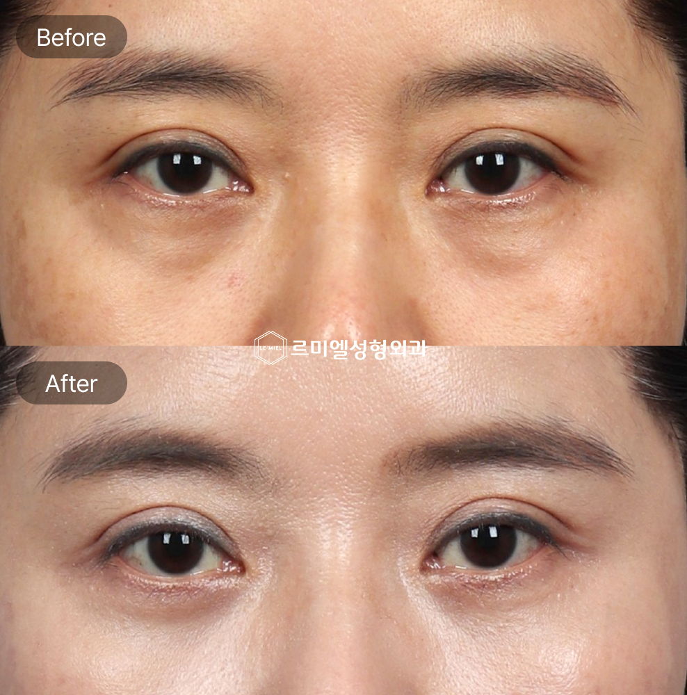 Before and After Results of Under Eye Fat Repositioning and Virtue RF Treatment After Three Months