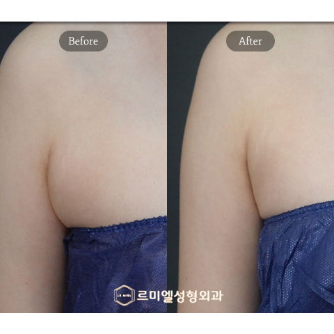 CoolSculpting Arm Body Fat Reduction Results After 3 Months