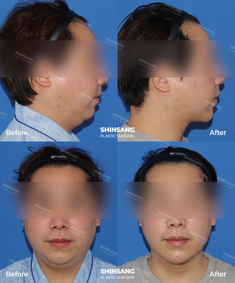 Double Chin Liposuction Before And After Patient Review At Sinsang Plastic Surgery In Korea