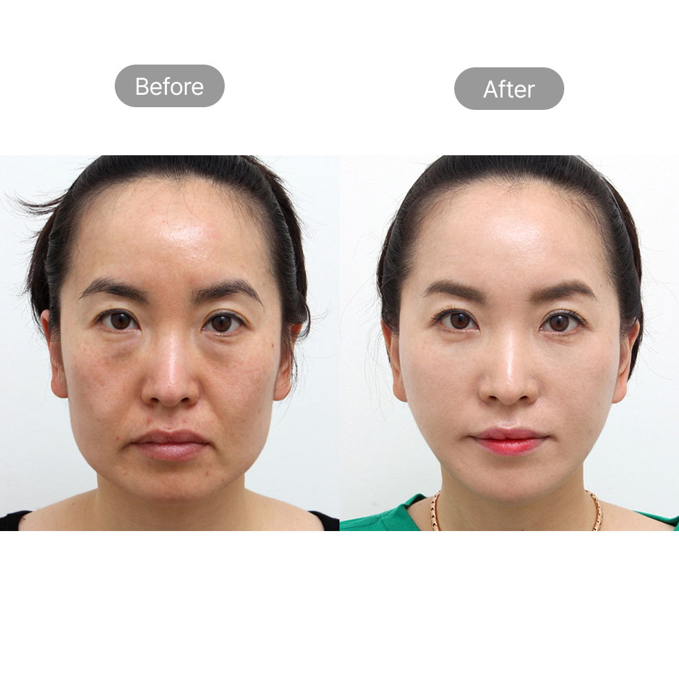 Full face fat grafting before and after results for facial volume restoration in Korea