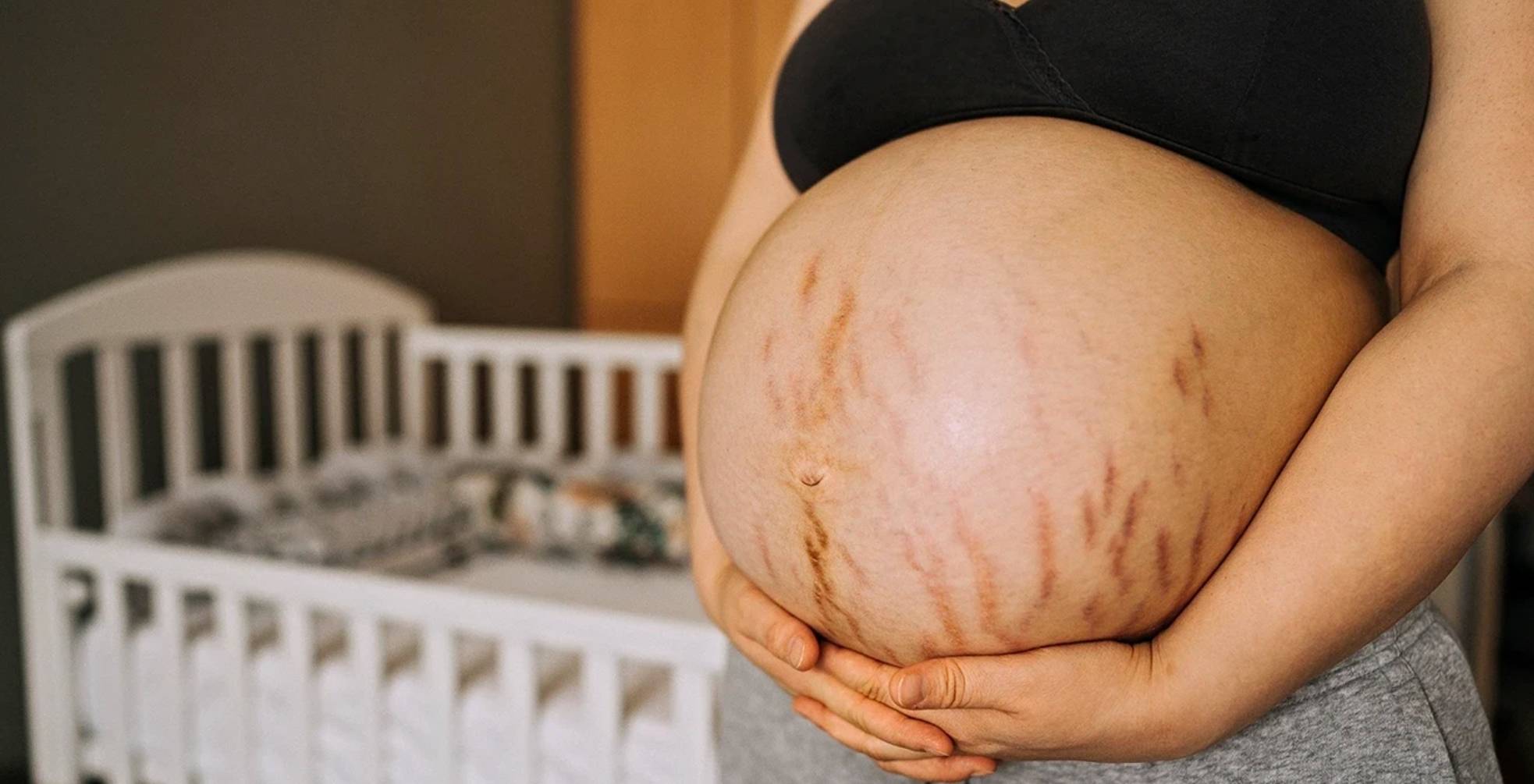 How to prevent Strech Marks during pregnancy? Depology Blog 