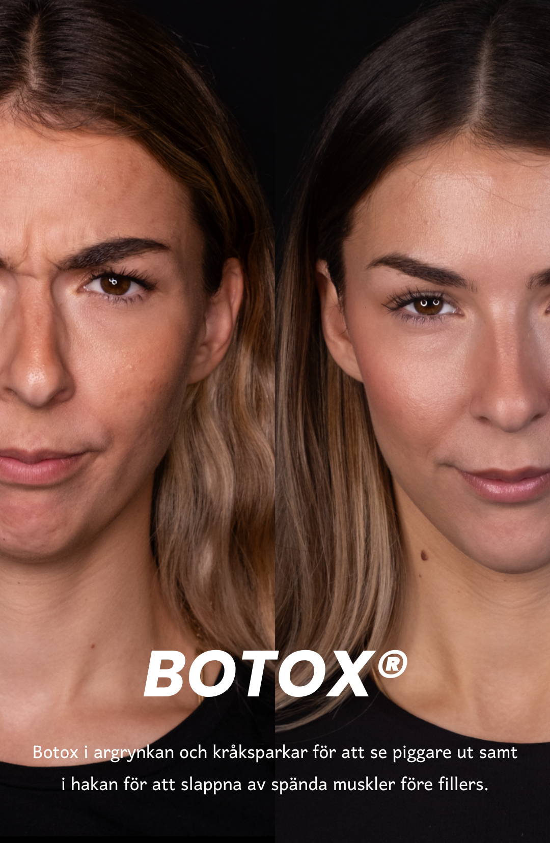 Side-by-side comparison of facial expressions showcasing Botox effects.