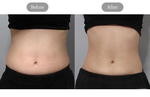 Before And After Comparison Image Of Abdominal Core Sculpt Body Contouring At Jfeel Clinic In Korea