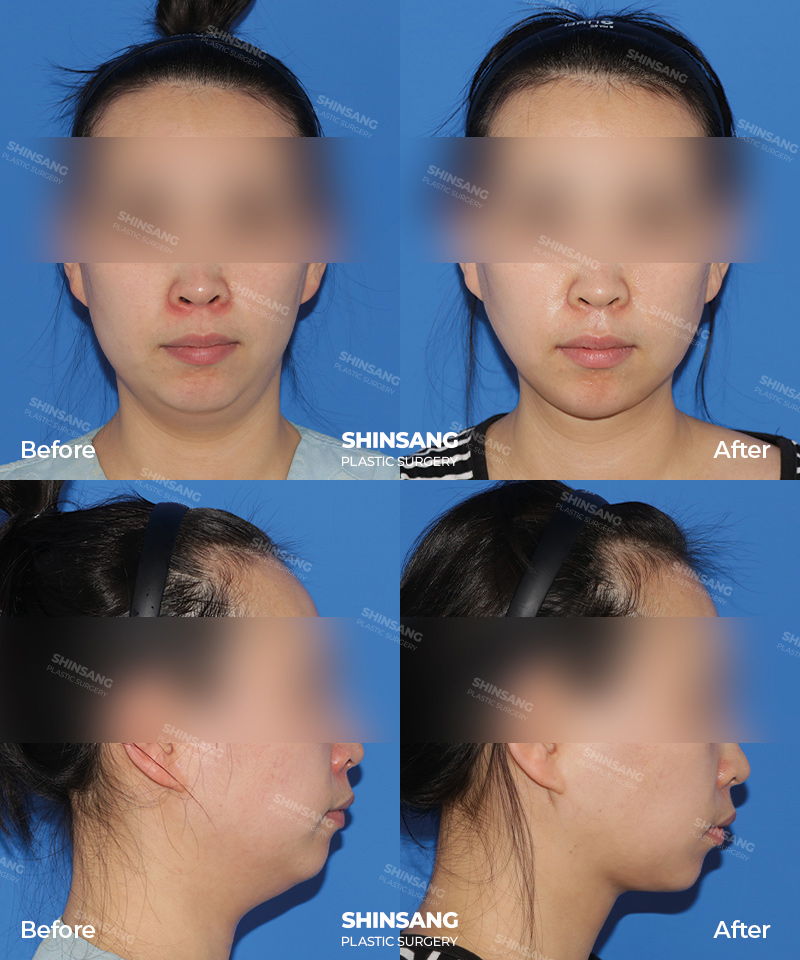 Platysma Muscle Tightening And Neck Lift Before And After Result At Sinsang Plastic Surgery In Korea