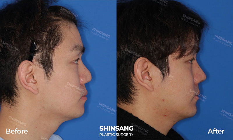 Revision Rhinoplasty Result At Sinsang Plastic Surgery In Korea