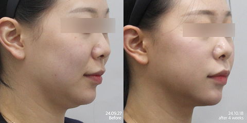 Jawline slimming and V-line lifting results for sagging skin after 4 weeks using Shurink HIFU and InMode RF treatments