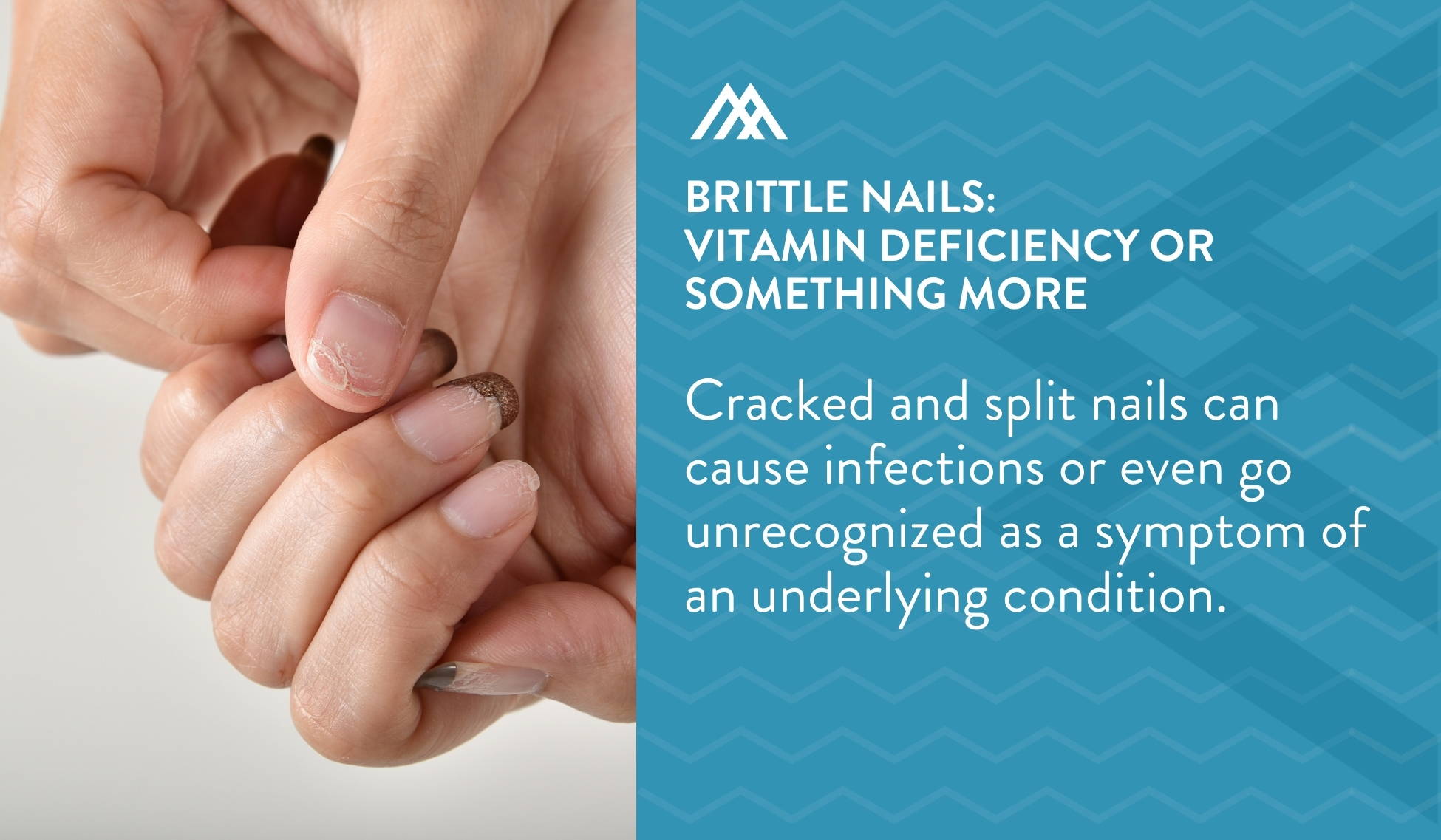 Brittle Nails: Vitamin Deficiency or Something More? - Amandean