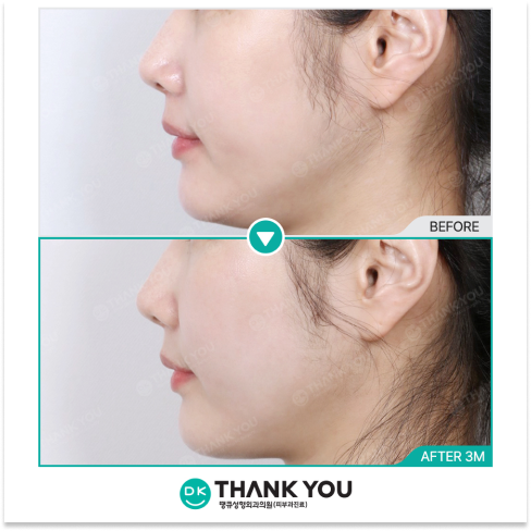 Collagen tightening results for sagging skin after 3 months with Thermage 600 shots showing improved skin firmness and contour